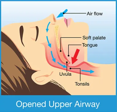 open airway sleep apnea diagram