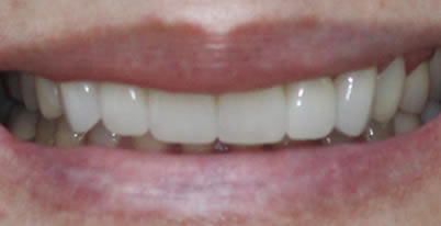 cosmetic dentistry patient after close up