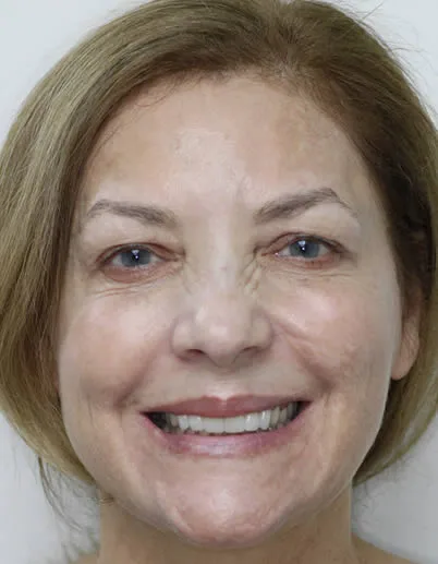 cosmetic dentistry patient after full face