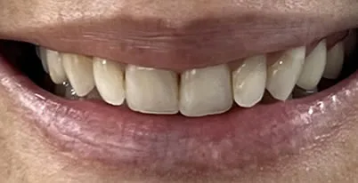 cosmetic dentistry patient before close up