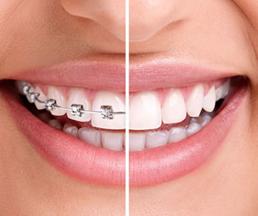 Advantages of Invisalign